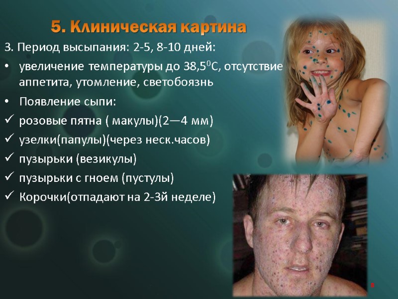 5. Клиническая картина 3. Период высыпания: 2-5, 8-10 дней: увеличение температуры до 38,50C, отсутствие